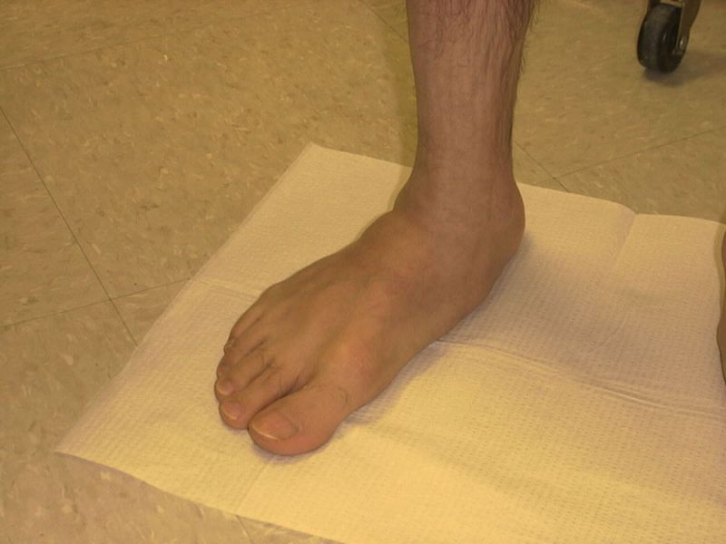 FlatFoot2.jpg